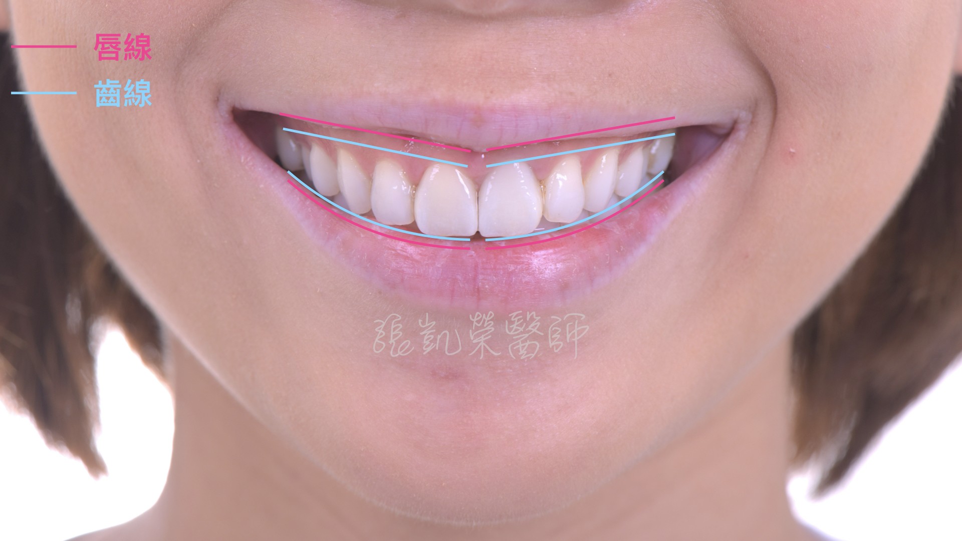 什麼是微笑曲線？ part I：嘴唇與牙齒的協奏曲